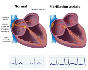 Schéma explicatif de la fibrillation atriale